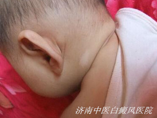 婴幼儿患上白癜风会有哪些原因导致
