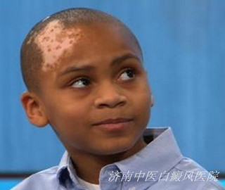 儿童面部出现白斑是什么症状