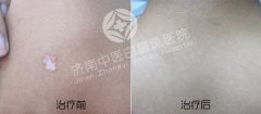 治疗白癜风要注意什么