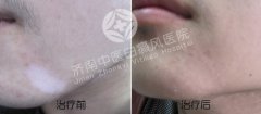 白癜风患者如何防辐射