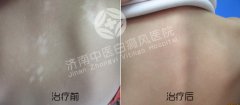 白癜风扩散后有什么危害